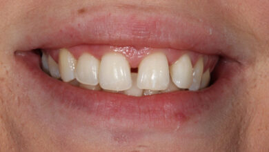 هزینه باندینگ دندان