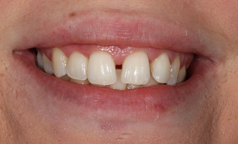 هزینه باندینگ دندان