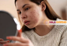 شایع ترین مشکل های پوست و مو در بارداری و راهکارها