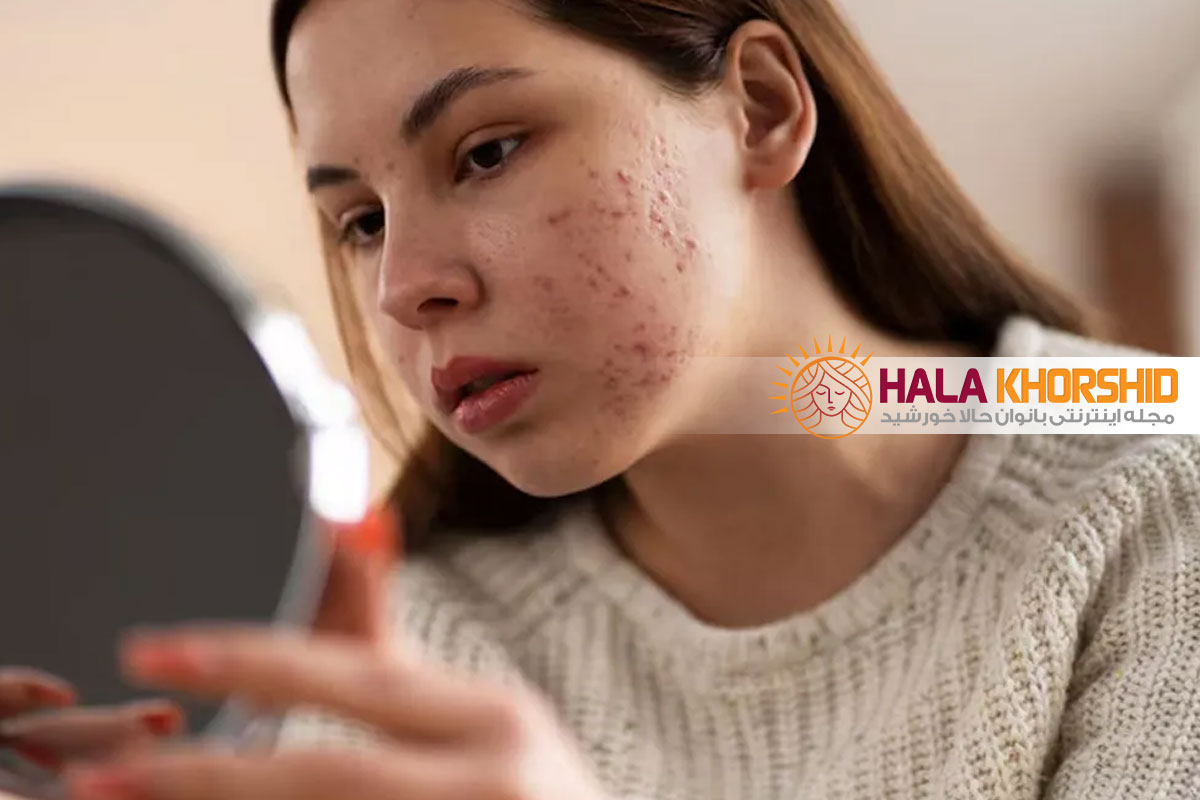 شایع ترین مشکل های پوست و مو در بارداری و راهکارها